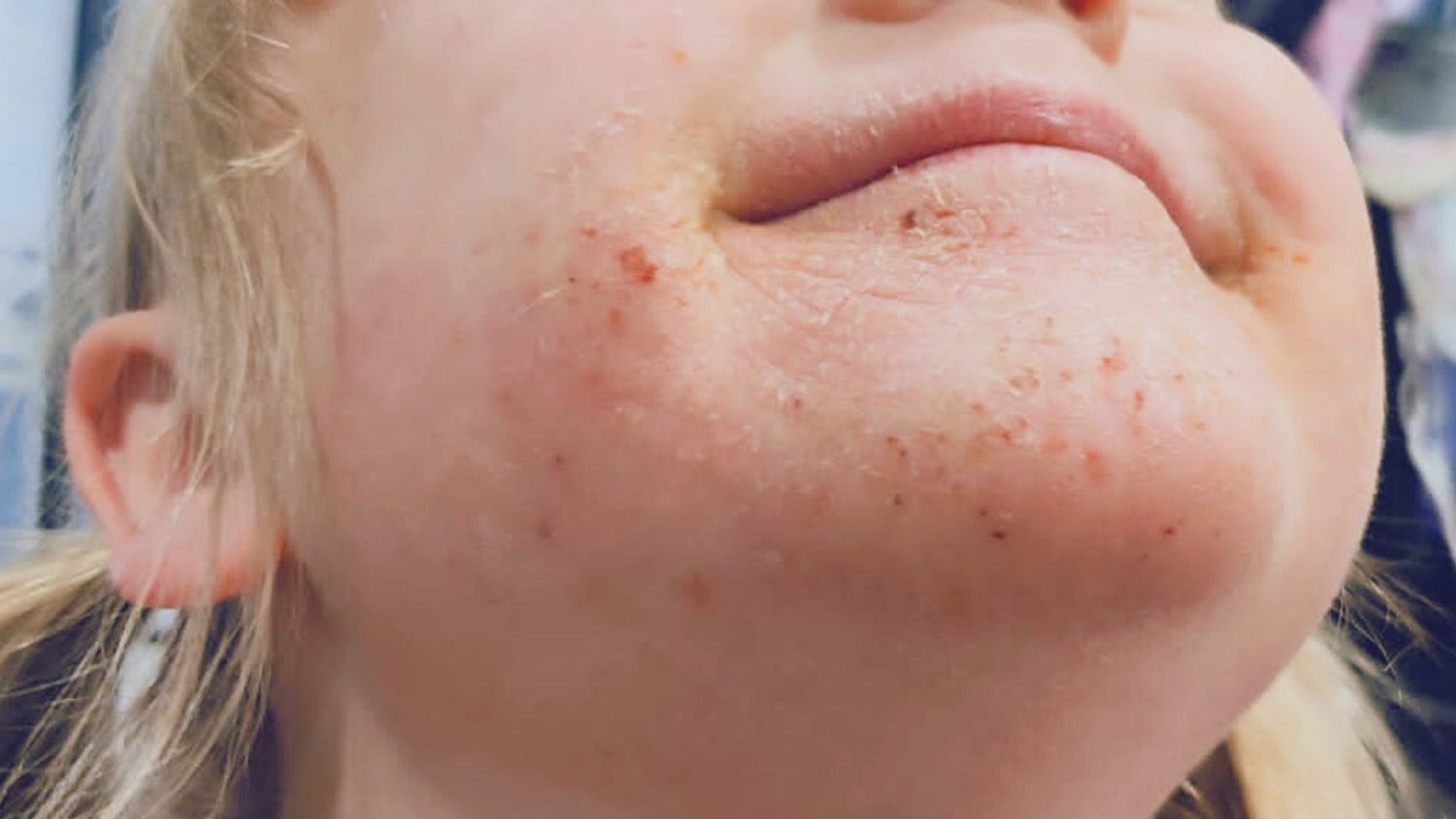 Atooppinen ihottuma - mistä se johtuu ja kuinka sitä hoidetaan?
