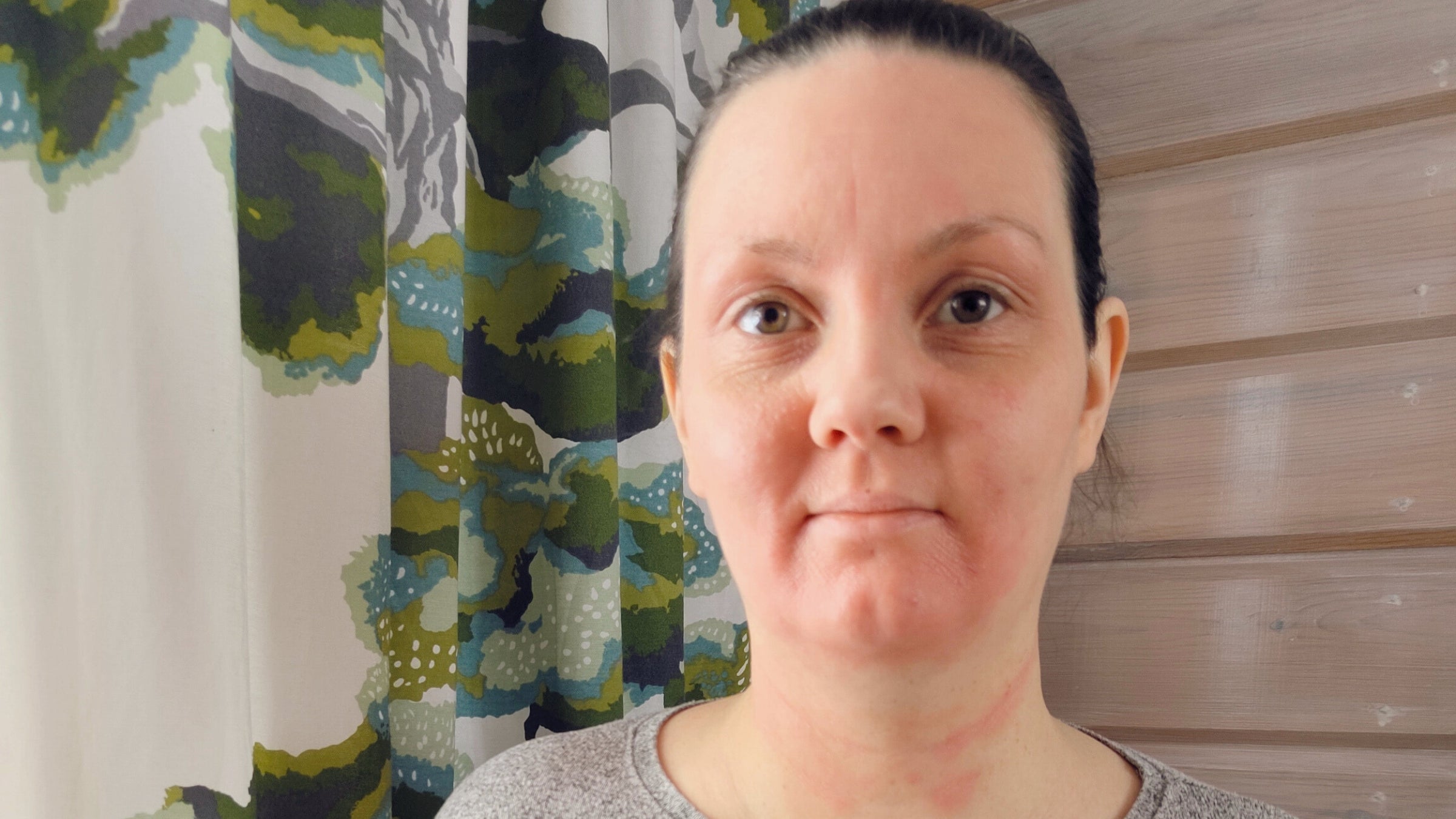 Voide, joka pelasti atooppisen ihoni! - Piritan tarina