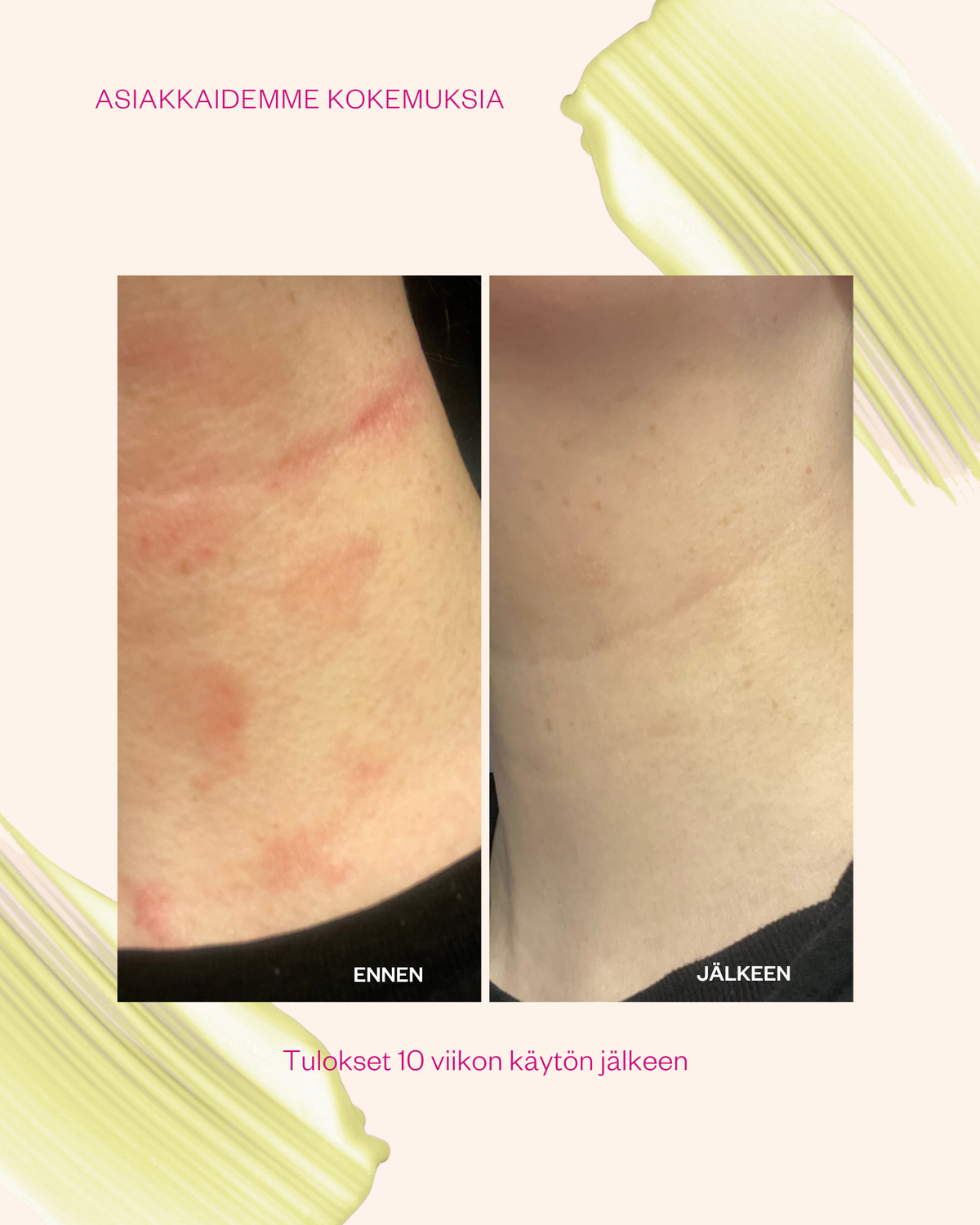 Propolis & Probiotics Rescue Cream erikoisvoide ongelmaiholle