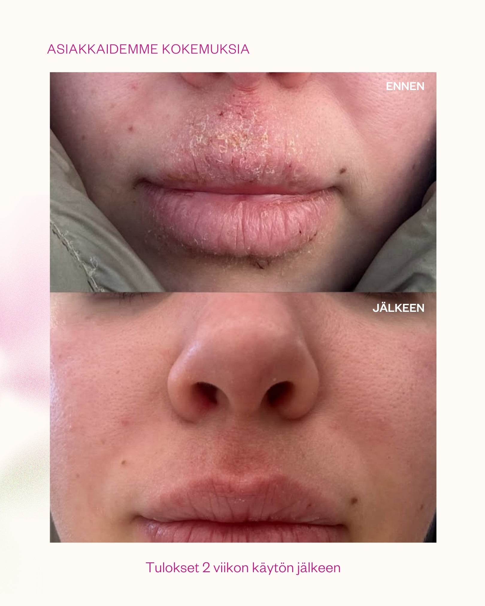 Propolis & Probiotics Rescue Cream erikoisvoide atooppiselle ja ongelmaiholle