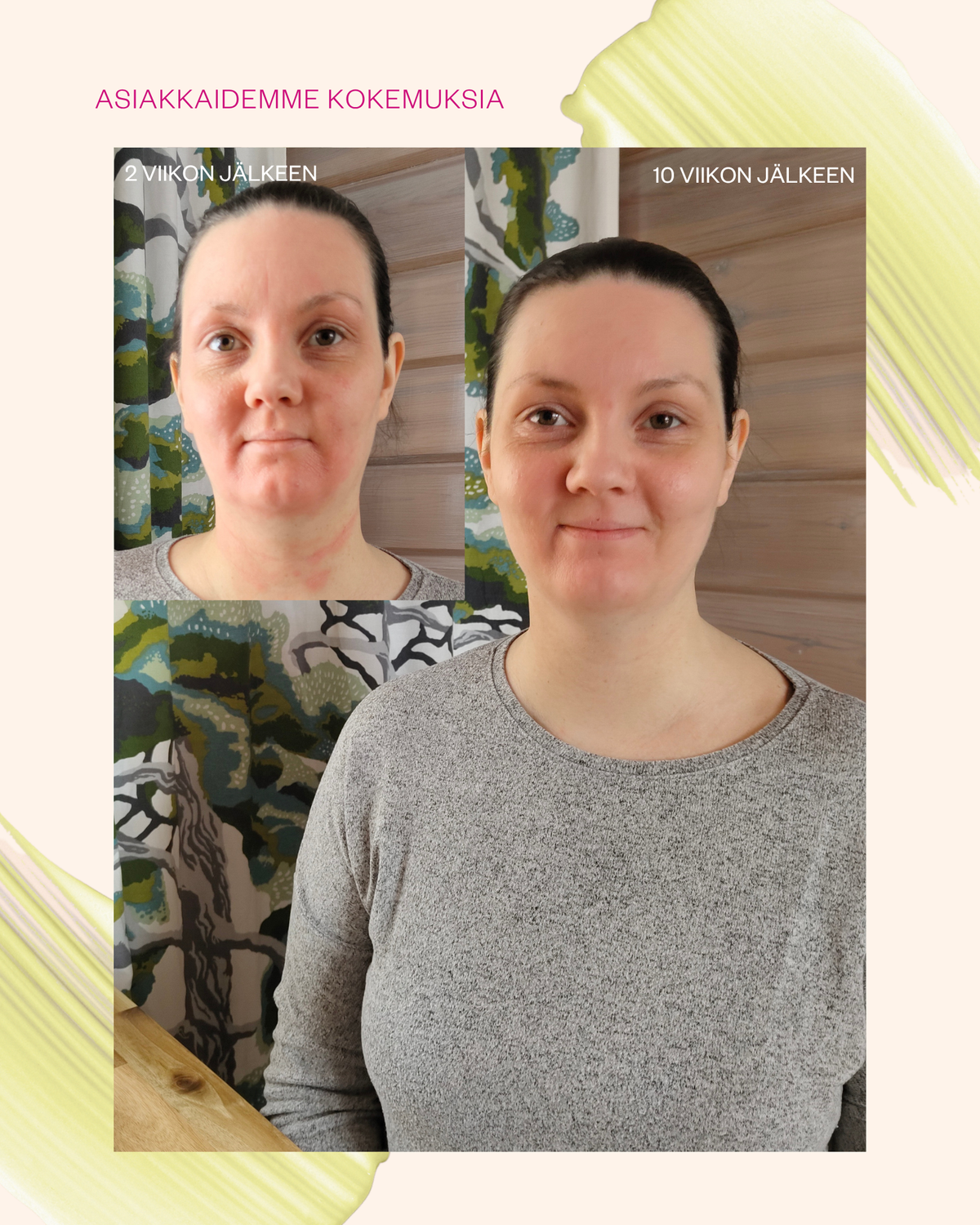Propolis & Probiotics Rescue Cream erikoisvoide ongelmaiholle
