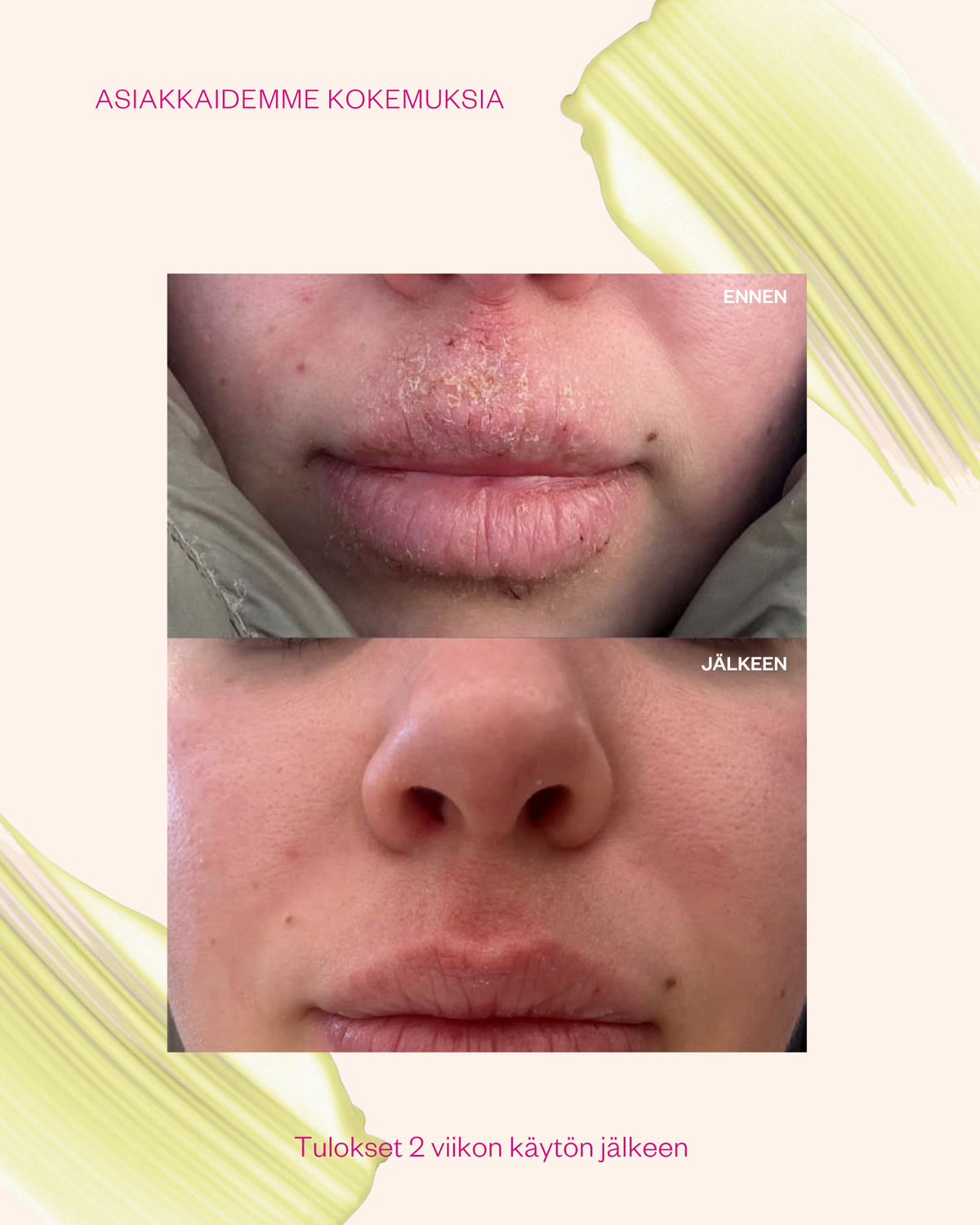 Propolis & Probiotics Rescue Cream erikoisvoide ongelmaiholle